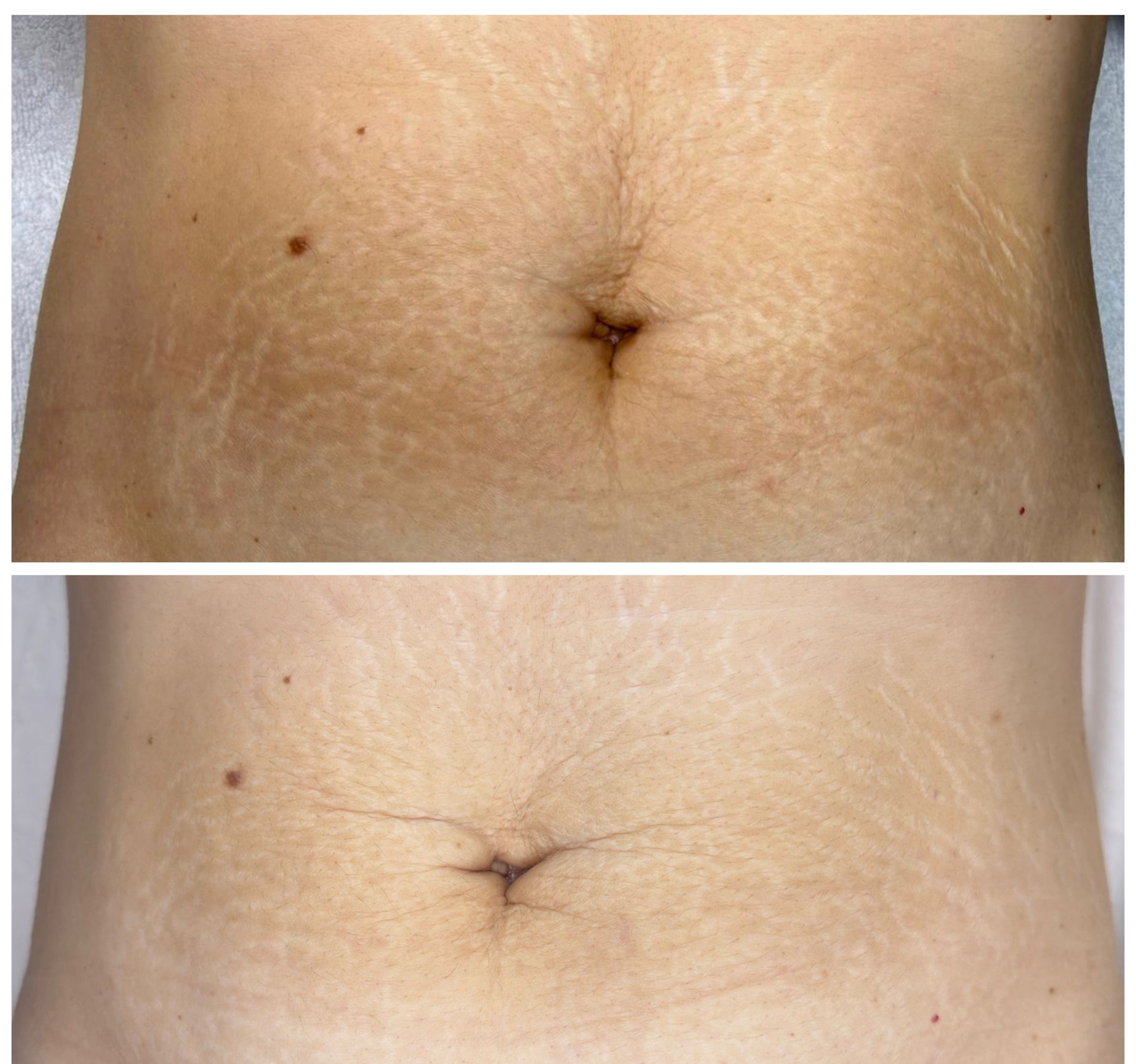 Kombinationsbehandlung: Radiofrequenz-Microneedling & Fraktionale Lasertherapie